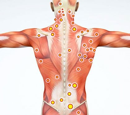 Trigger Point injections glendale